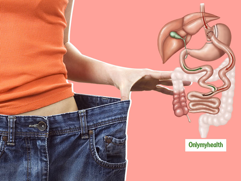Weight Loss Surgery Like Bariatric Can Be Harmful, Increased Risk Of Stones And Hernia